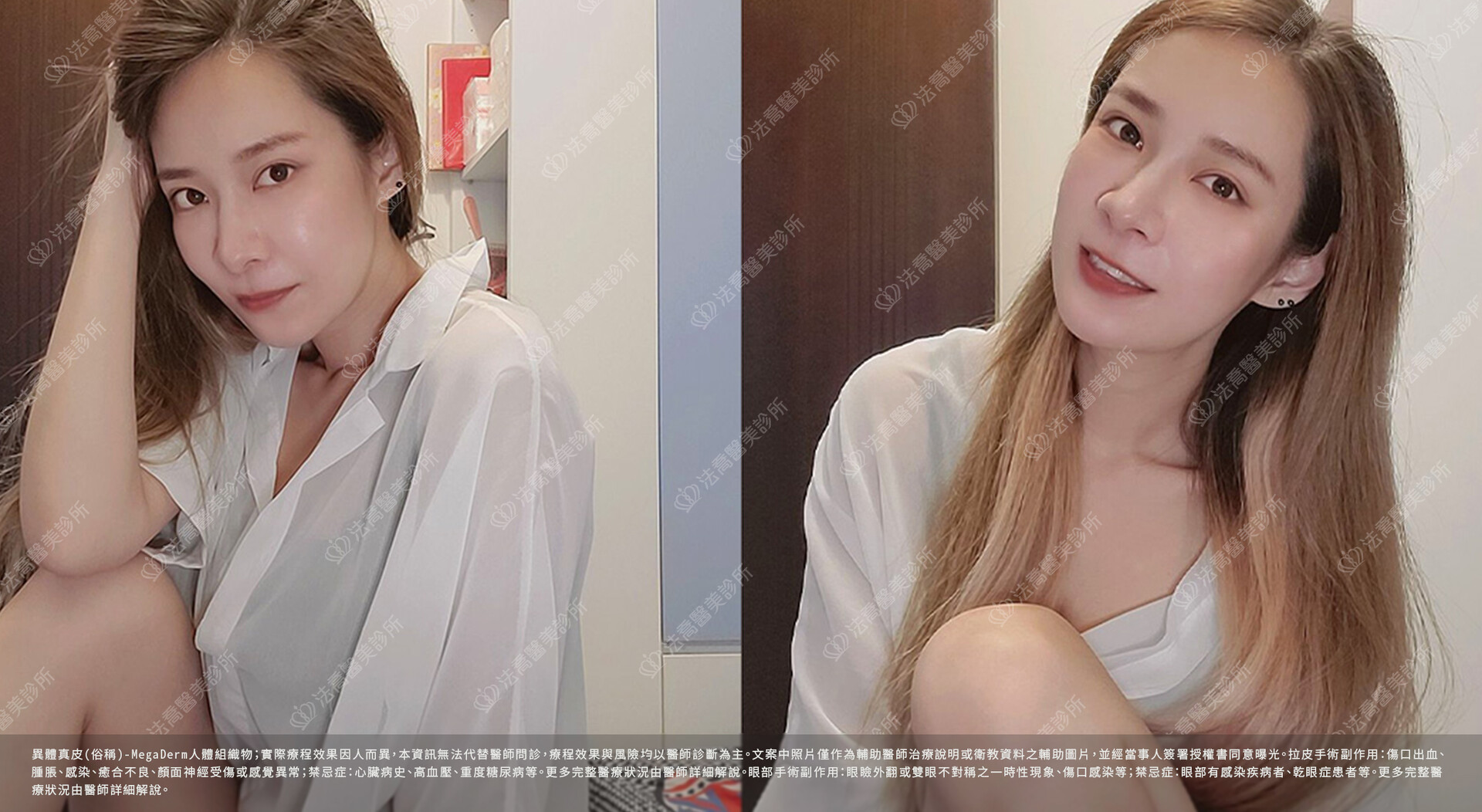 眼袋內開 脂肪移位 術後一個月 生活照