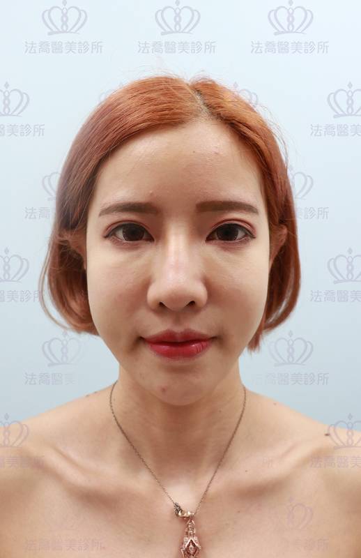 法喬醫美診所_微整術前照