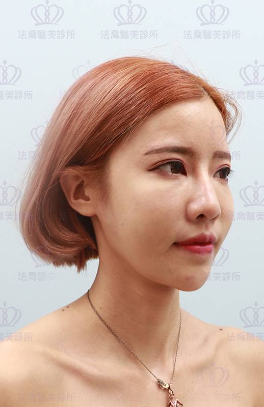法喬醫美診所_微整術前照