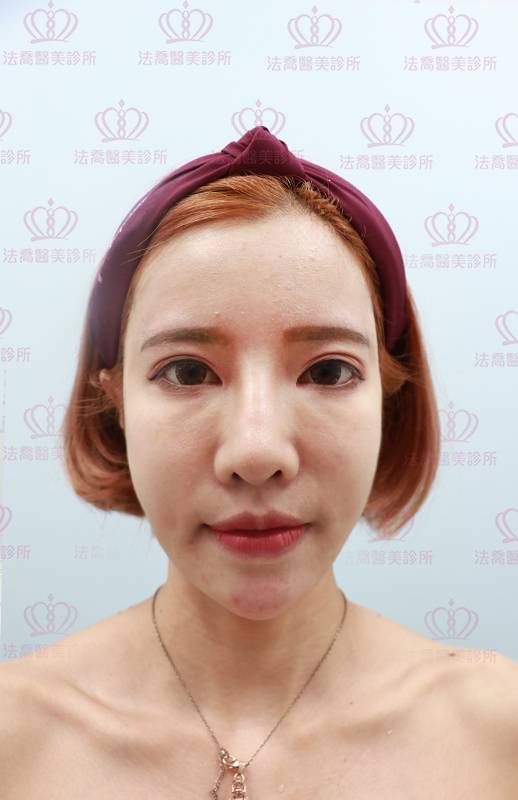 法喬醫美診所_Ellanse洢蓮絲當天術後