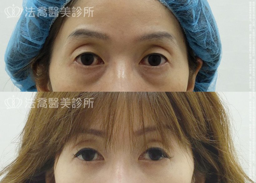 邱浚彥,法喬醫美診所,眼袋內開