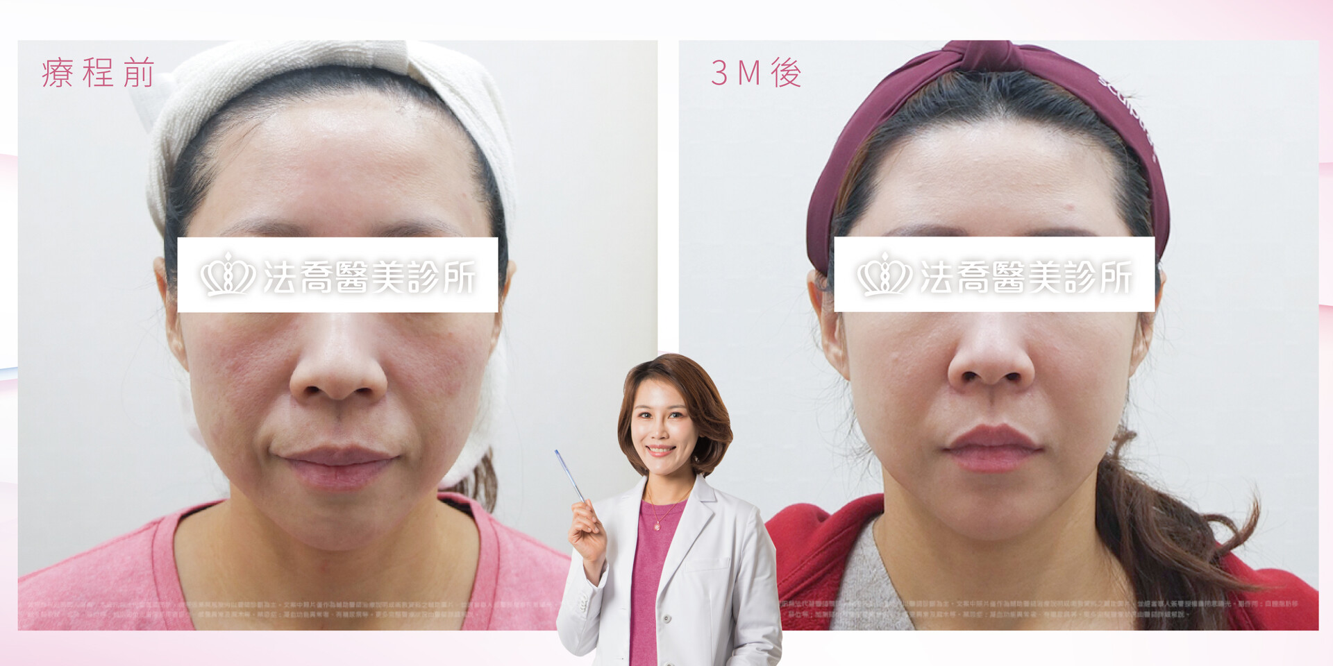 台中精靈針價格張慈恩醫師案例