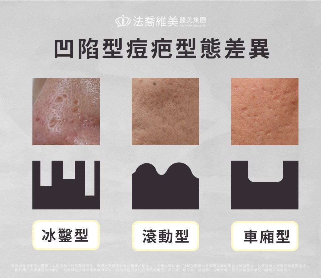 凹陷型痘疤型態差異