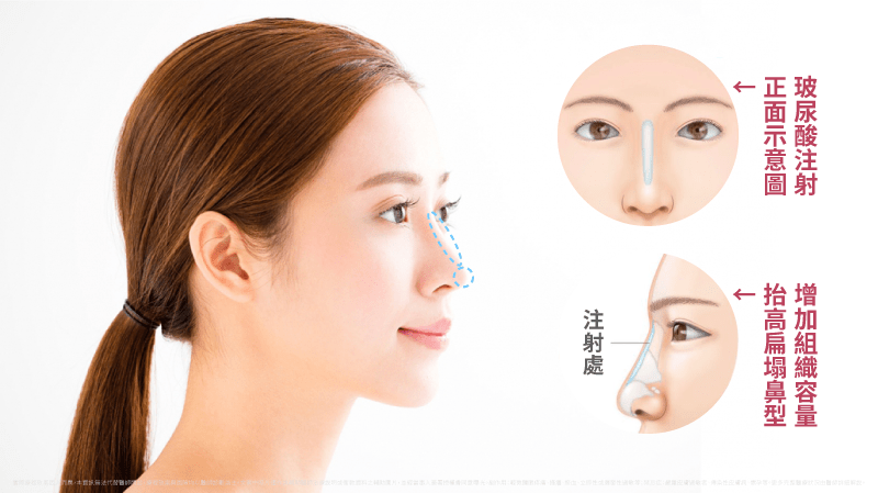 玻尿酸隆鼻注射示意圖