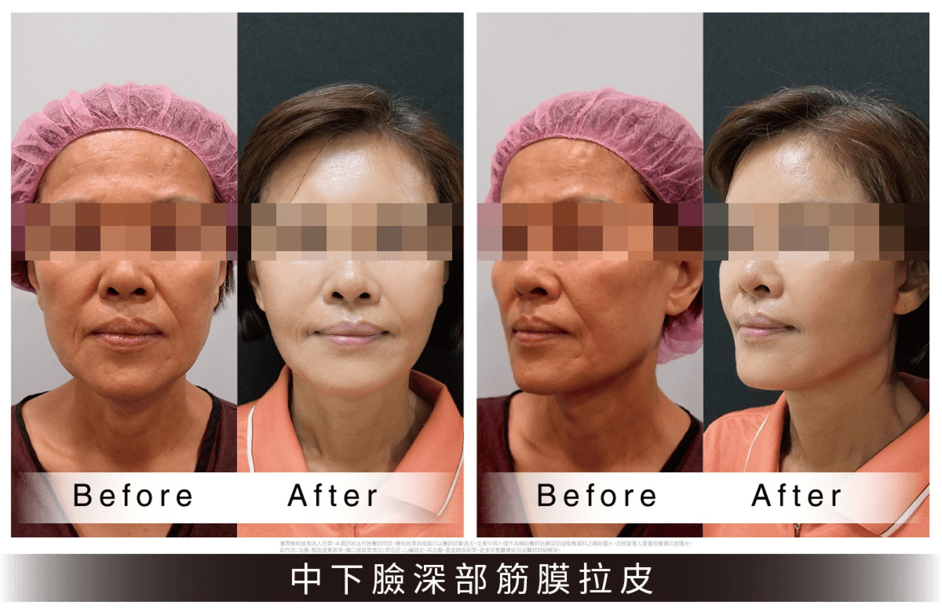 法喬邱浚彥拉皮