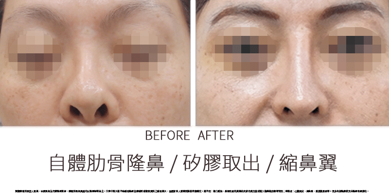 邱浚彥,法喬醫美診所,自體肋骨隆鼻