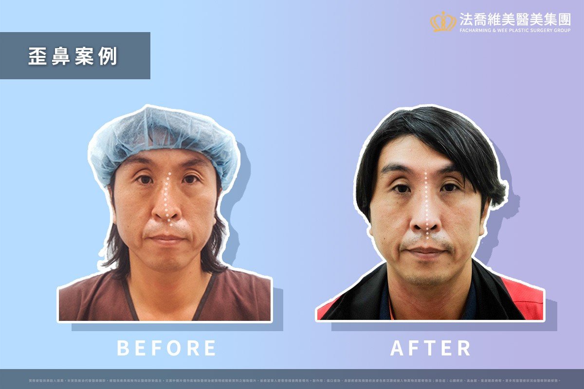 歪鼻案例