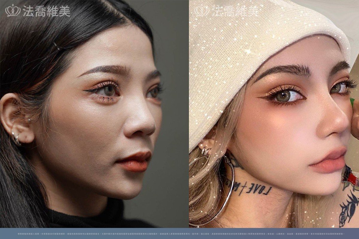 自體肋骨隆鼻案例